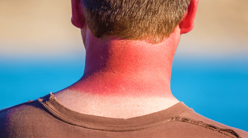 6 Good Natural Remedies to Relieve Sunburn