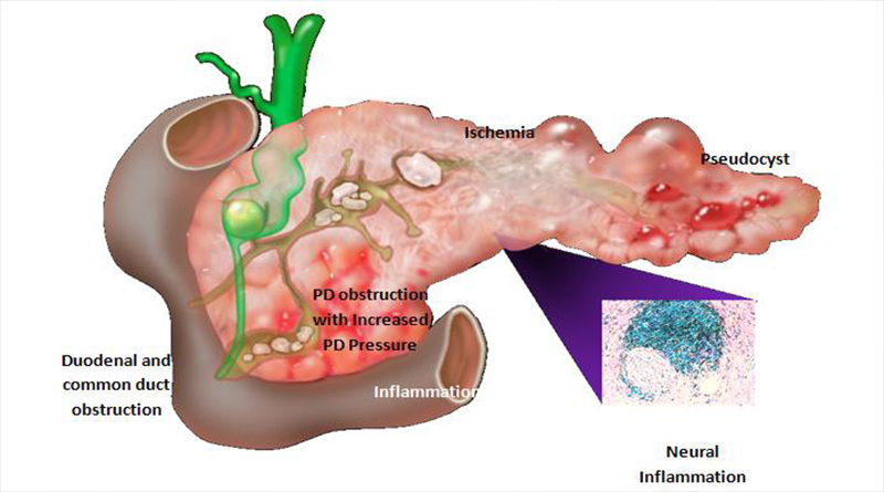6 Symptoms of a problem in the Pancreas