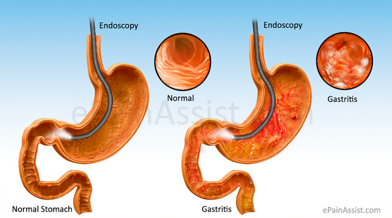 Symptoms Causes and treatment of Erosive gastritis