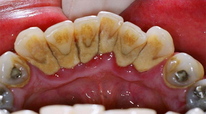 How to Remove Tartar from Your Teeth Naturally