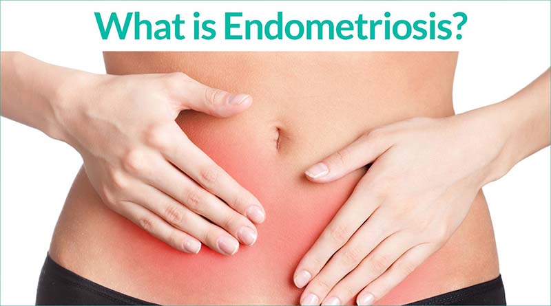Serious Symptoms of Endometriosis you should know